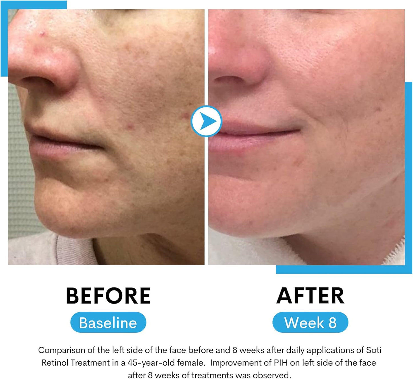 Soti Retinol Serum 2.5%