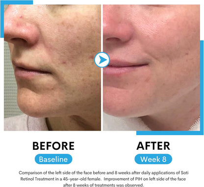 Soti Retinol Serum 2.5%