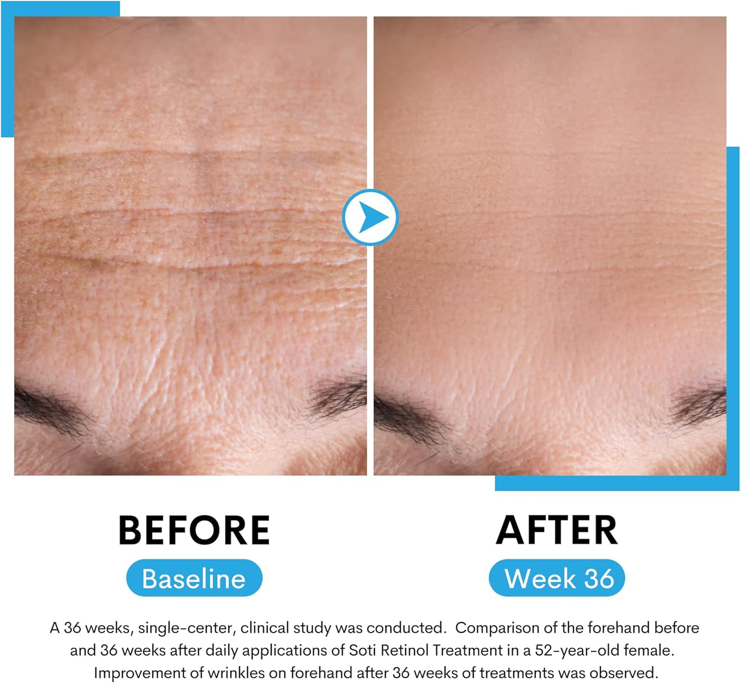 Soti Retinol Serum 2.5%